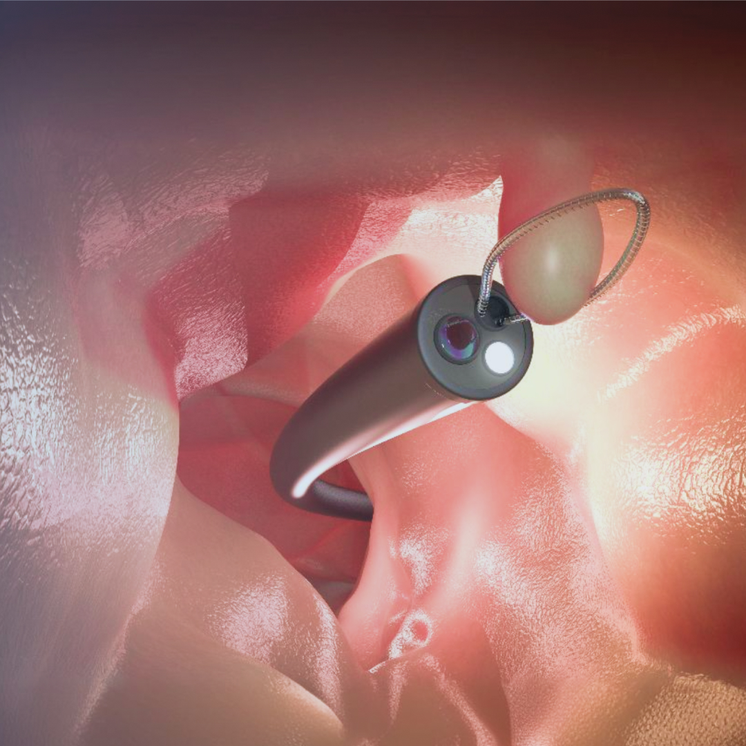 용종, 꼭 제거해야 할까?